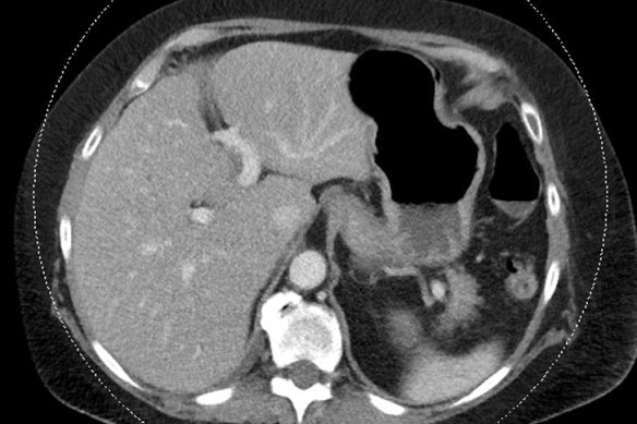 A CT scan of the abdomen showing unsuspected fatty liver, which can cause chronic liver disease, cancer and cardiovascular disease.