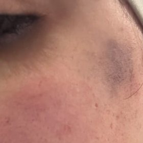 A close-up of a bruise Ealaf Al-Esawie sustained in the attack.