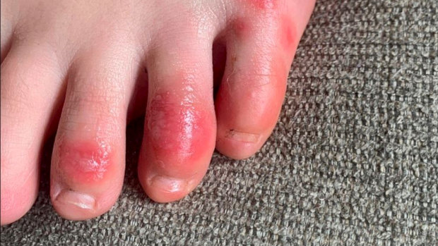 Discolouration on a teenage patient's toes at the onset of the condition informally called "COVID toes". 