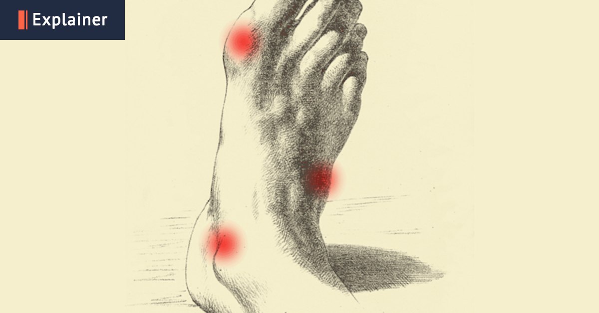 Bunions, corns, plantar fasciitis: How to nail foot trouble before it’s too late