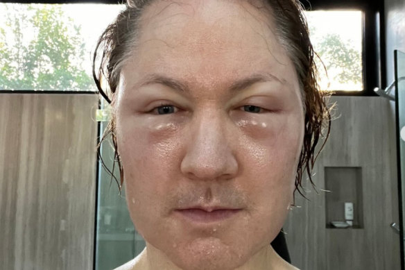 After his diet left him looking gaunt, Bryan Johnson injected fat into his face only to see it “blow up”.
