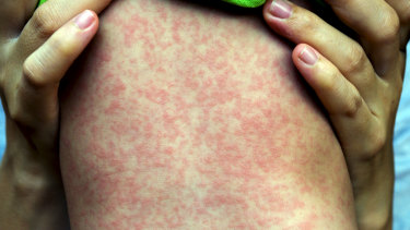 A man traveling back from Samoa has contracted measles. 
