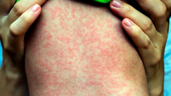 Measles is particularly dangerous for children.