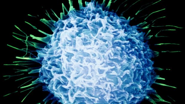 Image of a prostate cancer cell. Researchers say there is no need to use the 'c' word at the merest hint of cell change.