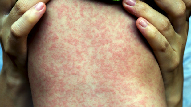 A third case of measles has been confirmed in Canberra