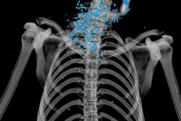 A CT scan shows a shotgun blast to the neck.