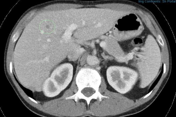 A CT scan shows an unsuspected liver nodule (dark area in the green ring), which is harmless.