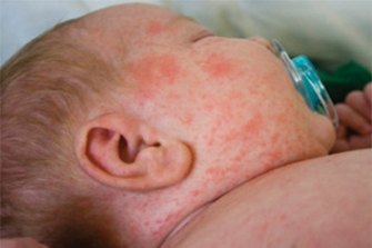 Passengers on a flight from Bali to Australia have been warned to look out for symptoms of measles