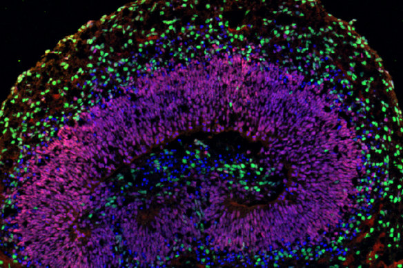 Some of the mini brains were infected with COVID, which research shows can cause cellular senescence in the brain.