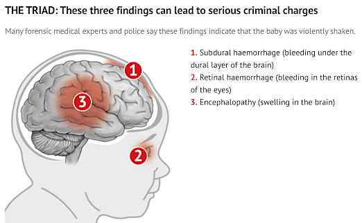 The signs of shaken baby syndrome.