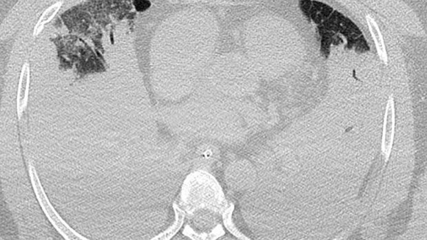 This CT scan from a deceased COVID-positive person shows lungs that are almost airless. The black areas at the top are air.