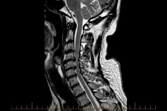 Rob Caruso, an incomplete quadriplegic, undergoes regular scans and tests of his spine but still suffers chronic pain. 