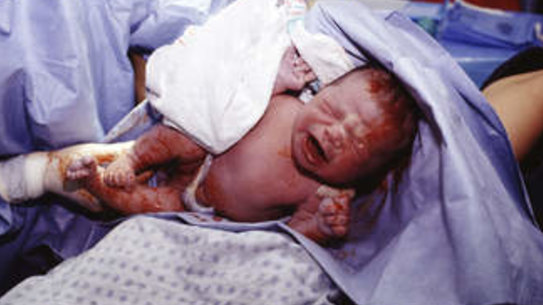 Revealed: Sydney hospitals with high rates of caesarean, forcep births