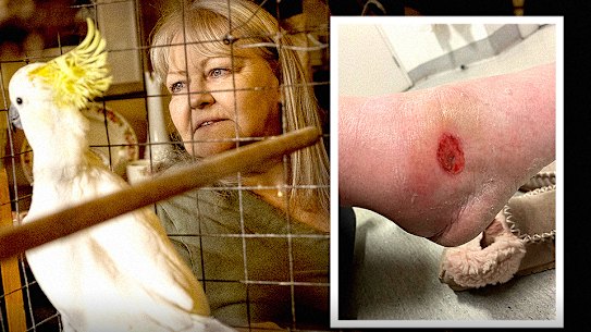 Fiona Wordie was diagnosed with a Buruli ulcer in June. She also has diabetes, a condition that researchers believe heightened her risk of developing the painful condition. 