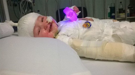 Charlie Burgess was just 11 months old when he suffered burns after taking the deep fryer off the kitchen counter.