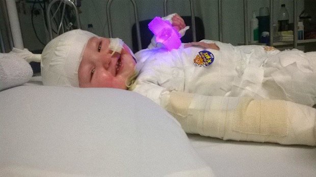 Charlie Burgess was only 11 months old when he suffered burns after pulling a deep fryer off the kitchen bench.