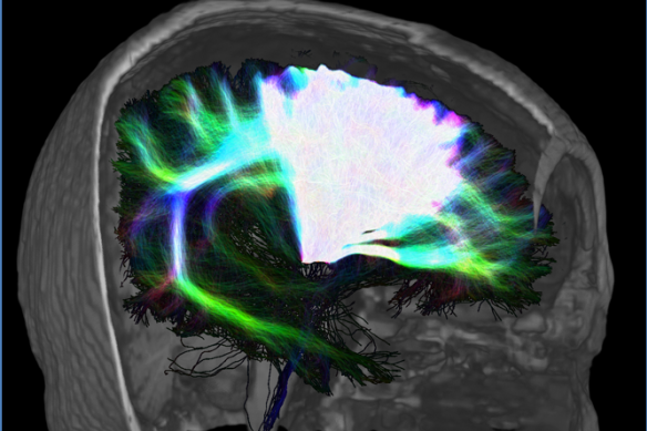 QIMR researchers used high-resolution MRI scans to create "wiring maps" of the brains of people with Parkinson's disease.