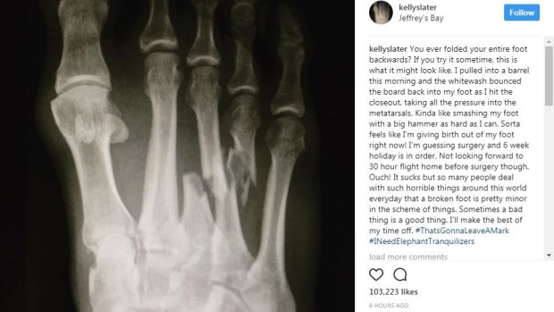 Kelly Slater posted this photograph of his broken foot on Instagram.