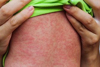 A second case of measles has been confirmed in the ACT