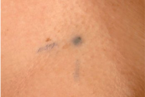 The tiny tattoos that mark thousands of cancer patients