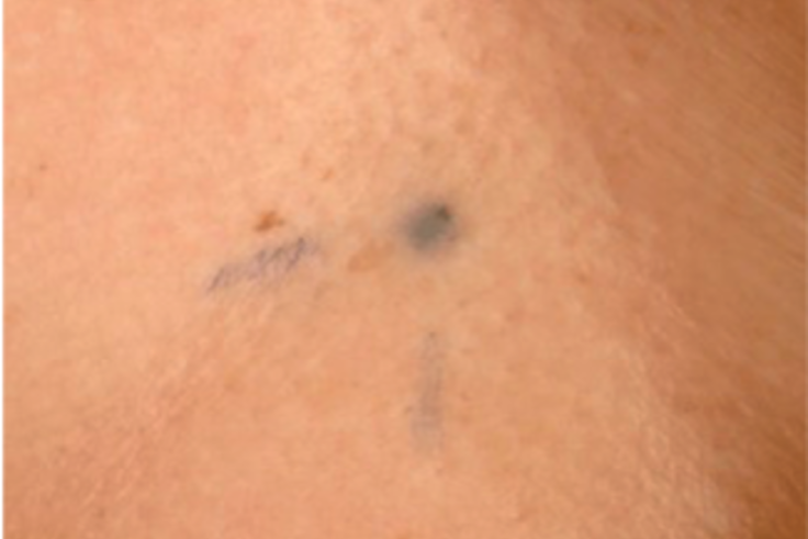 The Tiny Tattoos That Mark Thousands Of Cancer Patients