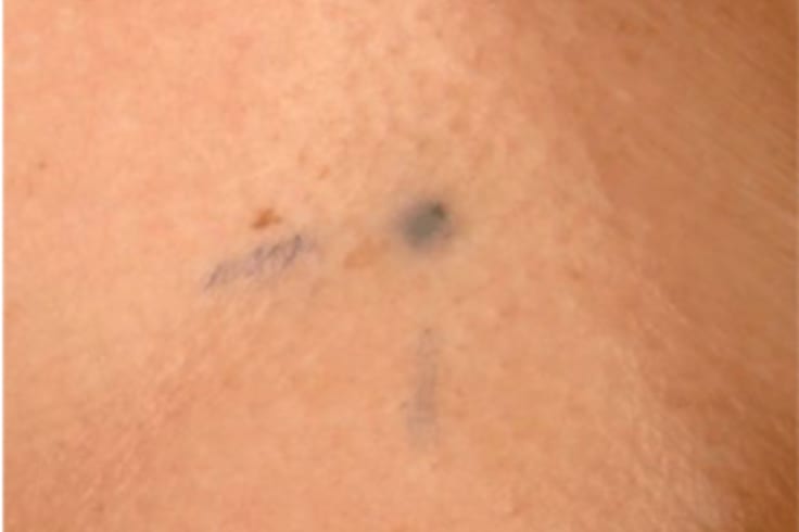 A radiotherapy tattoo.