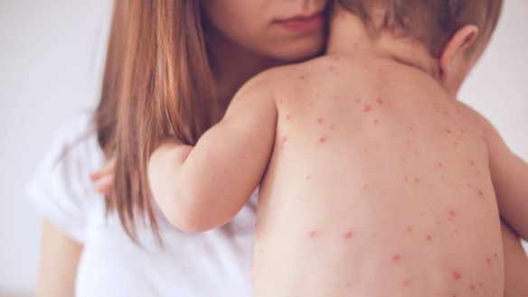 Assumed you were immune to measles and chicken pox? Think again