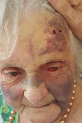 Frances Woolveridge was injured at a Japara aged care facility