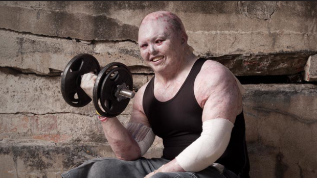 Dean Clifford suffers from a severe form of the genetic condition epidermolysis bullosa, which causes severe skin irritation, but still hits the gym regularly ahead of his 40th birthday.