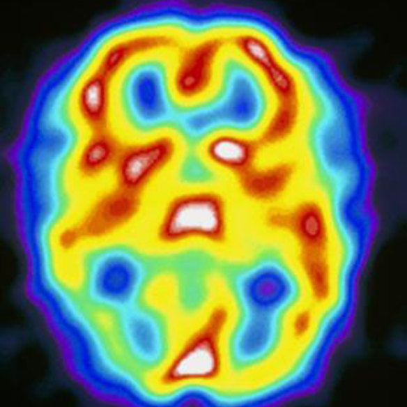 A brain scan taken during a migraine attack.