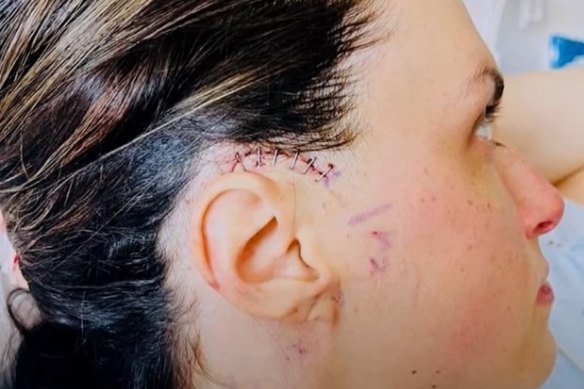 A woman interviewed by America’s <i>60 Minutes</i> says she was attacked by an energy weapon while stationed in Tbilisi, Georgia. She later had metal plates implanted in her head after her ears were permanently damaged.
