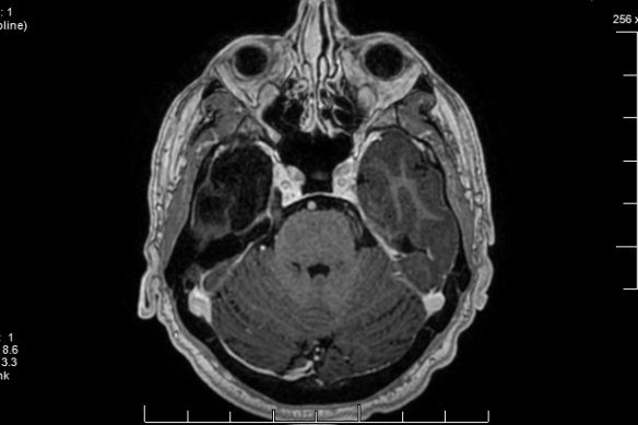A scan shows black spaces, on the left, where the condition eroded brain tissue in Geoff’s frontal lobe. 