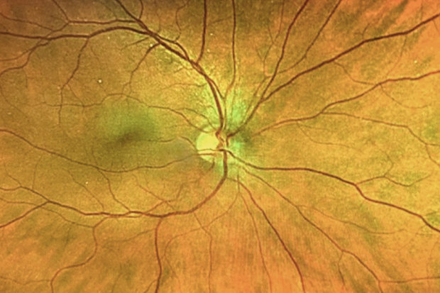 The human retina: End product of millions of years of evolution.