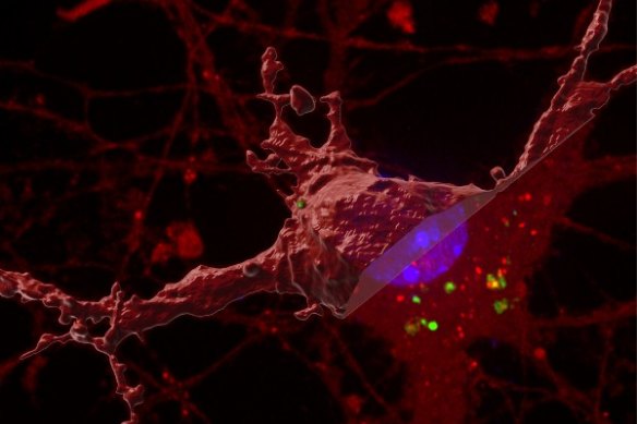 Researchers have identified how tau protein spreads around the brain to contribute to Alzheimer’s disease.