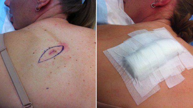 Oliver Peterson's wife Amy had a cancerous mole removed when the couple noticed it while putting on sunscreen. 