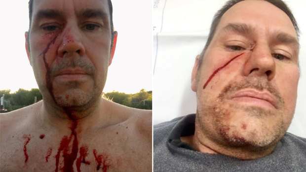 James Taylor was hit by a stingray barb at Mullaloo Beach on Monday. 