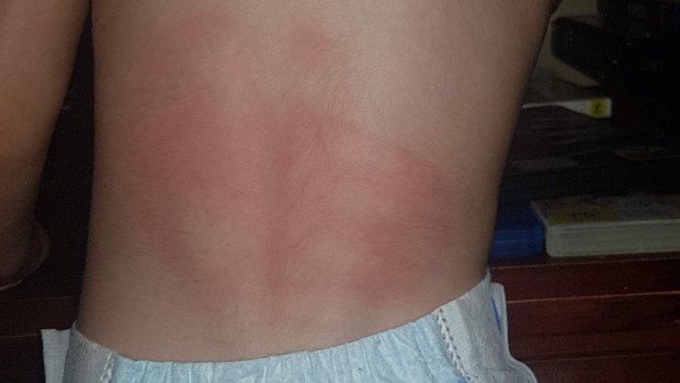 Matt slapped his brother so hard the toddler was left with a red handprint on his back. 