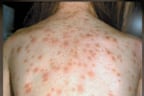 Symptoms of measles include a general fever, sore eyes and a cough that is followed a few days later by a blotchy rash that spreads from the head and neck to the rest of your body.