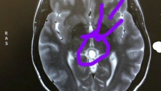 The tumour in Rachel's brain. 