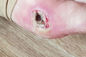 Mary Taouk’s foot wound as at December 6, 2017. Lawyers acting on behalf of her family allege she should have been hospitalised by this date.