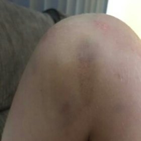 These images of another child's initial injuries were emailed to the minister's office the same day they were inflicted in November.