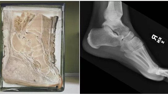 A cross-section of an elephant's foot, left, compared to a human foot, showing the striking similarities in bone structure.