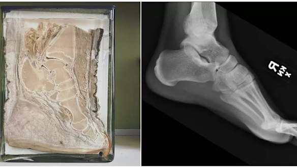 A cross-section of an elephant's foot, left, compared to a human foot, showing the striking similarities in bone structure.