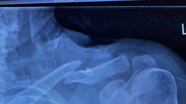 Kerri-Anne Kennerley's X-Ray reveals the broken collarbone after last week's fall.