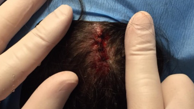 Canberra Capitals star Kelsey Griffin was busted open by an elbow from Asia Taylor in the WNBL.