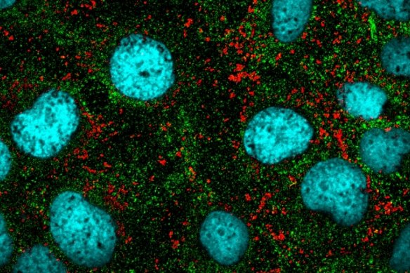 In another study into nanoparticles and cancer, UK scientists coated gold nanoparticles (shown in red) with chemotherapy drugs so they could precisely target cancer cells (blue/green areas).