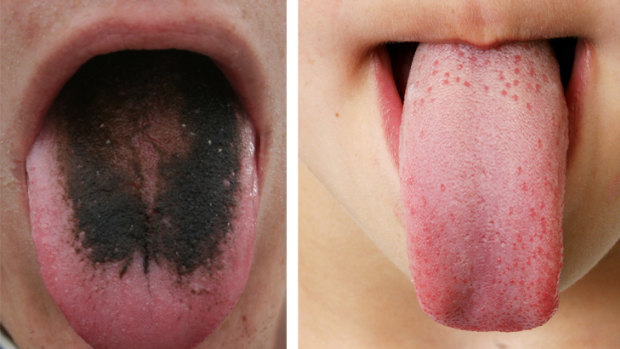 A medical condition known as black hairy tongue and a healthy tongue.