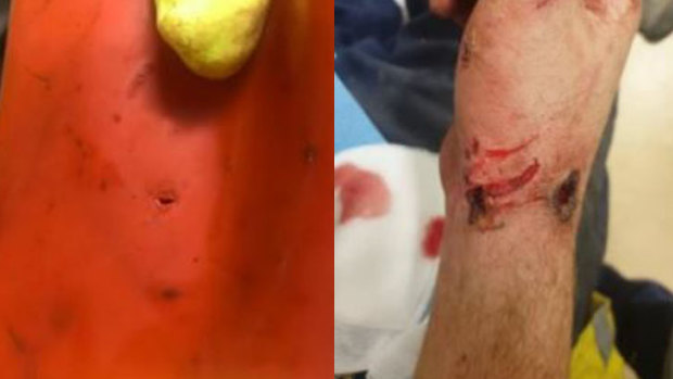 The tiny hole puncture (left) resulted in severe injuries to the worker.