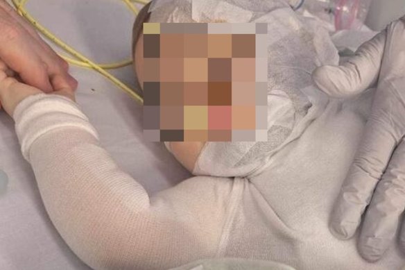 Luka ficou gravemente escaldado e passou por diversas operações para tratar queimaduras no rosto, pescoço e peito. 