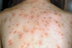 Symptoms of measles include a general fever, sore eyes and a cough that is followed a few days later by a blotchy rash that spreads from the head and neck to the rest of your body.